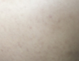 Skin Problem