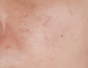 Pimple On Face 