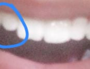 Teeth Defect