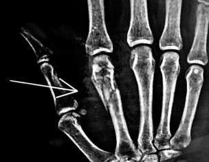 Bone Fracture