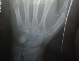 Bone Fracture