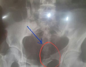 Hip Joint Bone Broken