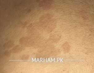 Brown Patches On Back 