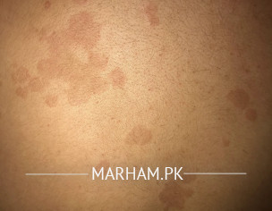 Brown Patches On Back 