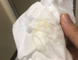 Discharge During Pregnancy