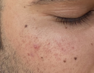 Acne Is Back Again