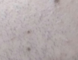 Flat Mole Removal