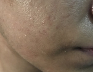 Oily Skin 