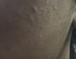 Oily Skin 