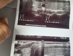 Lymph Node In Neck 