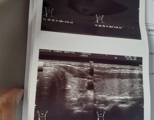 Lymph Node In Neck 