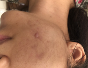Scab On Skin