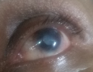 Eyes Problem 