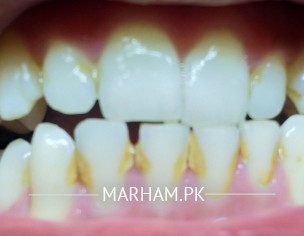 Dental Problem