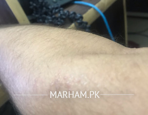 Rash Over Skin