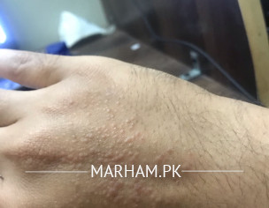 Rash Over Skin
