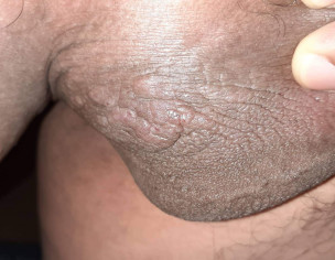 Itching Scrotum Area