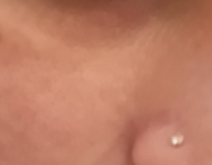 Pigmentation 