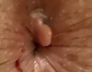 Piles/ Pain