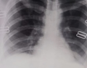 Covid Patient 
