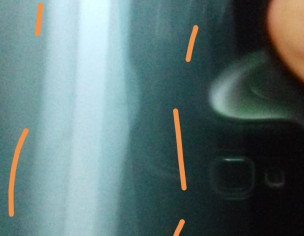 Thigh Bone Broken 