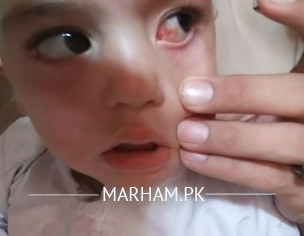Eye Problem