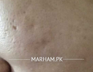 Deep Acne Scar 
