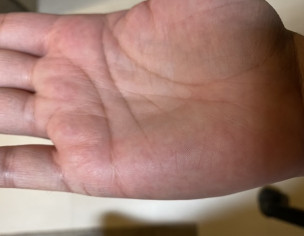 Pink Spots On Hands