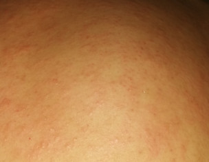 Pimples On Skin