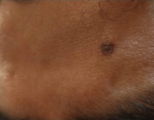 Warts Removal