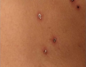 Warts Removal