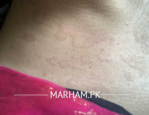 Skin Problem 