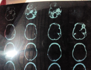 Brain Shirnkage
