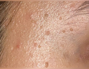 Skin Bumps On Face
