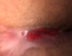 Pilonidal