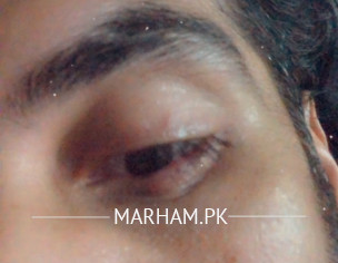 Pimple Inside Eye 