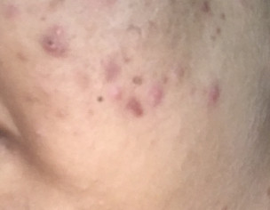 Acne Skin 