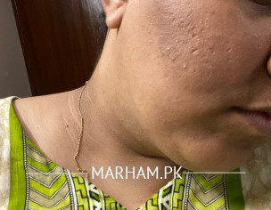 Black Patch On Chin