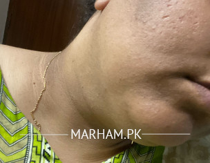 Black Patch On Chin