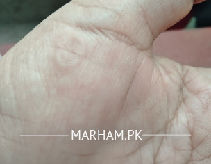 Patch In Palm