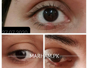Eye Stye