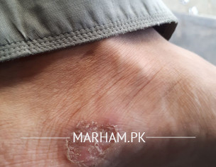Skin Problem