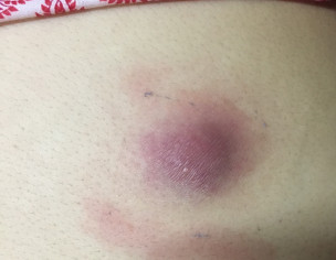 Pimple Without Head