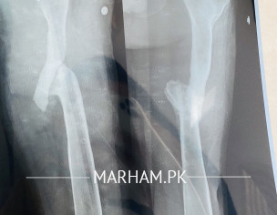 Right Leg Problem