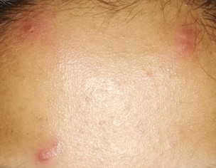 Skin Problem