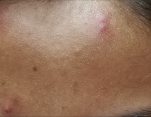 Skin Problem