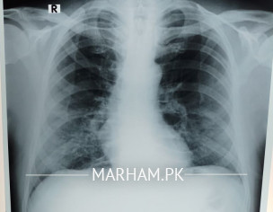 Chest X Ray 