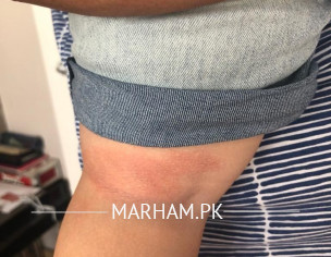 Skin Problem