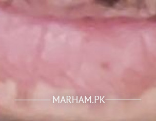 Lips' Scars