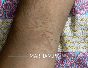 Skin Problem